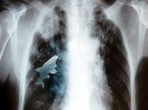 Բժիշկները երեխայի թոքի մեջ կենդանի ձուկ են հայտնաբերել
