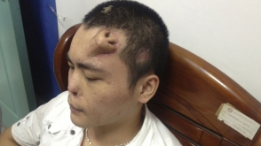 Китайские медики вырастили нос на лбу пациента