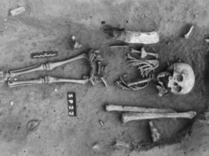 Во Франции обнаружен самый древний скелет больного синдромом Дауна