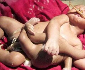 Հնդկաստանում 8 վերջավորությունով երեխա է ծնվել. նրան աստվածացրել են