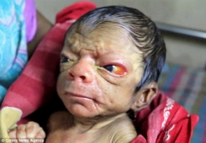 Բանգլադեշում 80–ամյա ծերուկի տեսքով երեխա է ծնվել (տեսանյութ, ֆոտոշարք)