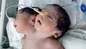 В Индии родился двухголовый ребенок