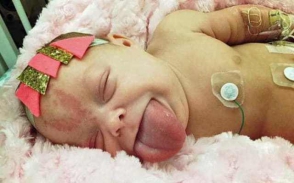 Վիրահատությունից հետո մեծ լեզվով ծնված փոքրիկը կարողացել է առաջին անգամ ժպտալ (լուսանկարներ)