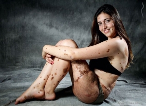 Աղջիկը, որին ծաղրել են 500 խալ ունենալու համար, մոդելային կարիերա է սկսել (ֆոտոշարք)