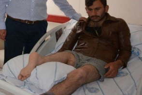 Турецкие врачи пришили пациенту ногу в обратном направлении (видео)