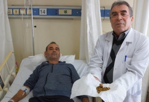 Թուրքիայում ստամոքսի ցավի գանգատով հիվանդանոց դիմած քաղաքացու մարմնից 250 հատ քար է հեռացվել