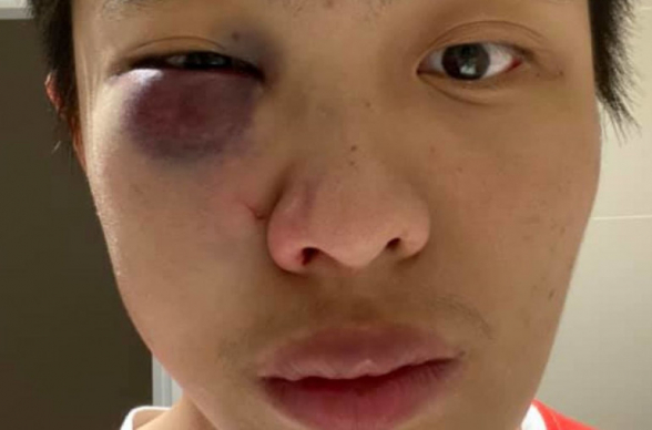 Լոնդոնում կորոնավիրուսից վախեցած անցորդները հարձակվել և ծեծել են չինացի ուսանողին (լուսանկարներ)