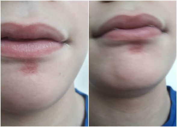 Նախարարն ասում է` բողոք չկա․ էլ ոնց ասենք, որ տեղ հասնի հարգելի նախարար․ տղայիս դունչն է․ առաջին օրը դպրոցում մոտ մեկ ժամ դիմակն անդադար դնելուց հետո