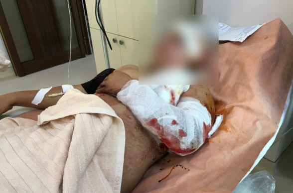 Նախնական տվյալներով` Արցախում քաղաքացիական բնակչության շրջանում կա 2 զոհ ու տասնյակ վիրավորներ,  Ստեփանակերտում 10-ից ավելի վիրավոր կա, ներառյալ՝ երեխաներ ու կանայք. ԱՀ ՄԻՊ (լուսանկար)