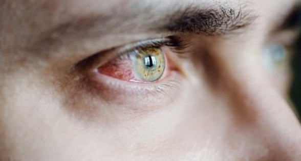 Կորոնավիրուսը հայտնաբերվել է պացիենտի աչքերի մեջ ապաքինվելուց 2 ամիս անց