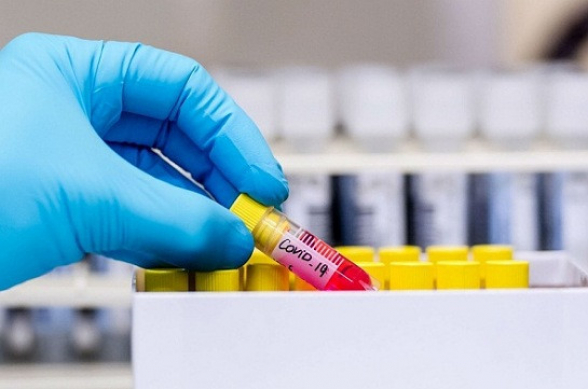 10 մահ՝ 1 օրում․ կորոնավիրուսով վարակվելու 138 նոր դեպք է արձանագրվել Հայաստանում