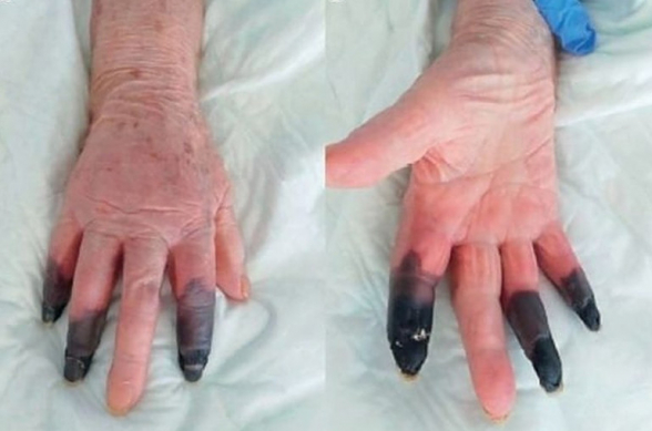 Կորոնավիրուսի հետևանքով տարեց իտալուհու մատները սևացել են․ բժիշկները ստիպված են եղել անդամահատել դրանք (լուսանկար)