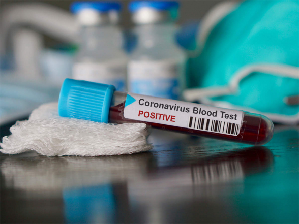 За сутки в Армении выявлено 870 новых случаев коронавируса, скончались еще 33 человека