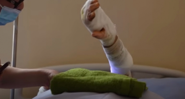 Ոսկորին հասած այրվածքներով հայ զինվորները. «ադրբեջանական քիմիա»