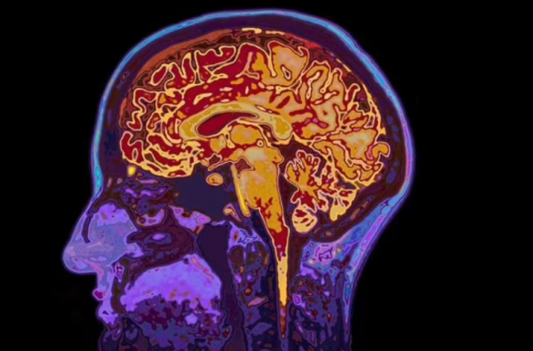 Շոտլանդացին ուղեղի ուռուցքի նոպայից հետո սկսել է խոսել ու մտածել միայն ֆրանսերեն